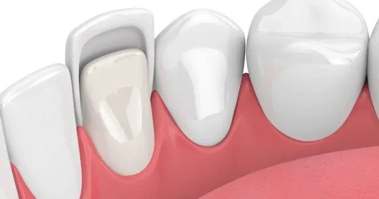 Facettes dentaires près de moi : un parcours vers un sourire confiant avec les facettes et implants dentaires chez Smile Boutik