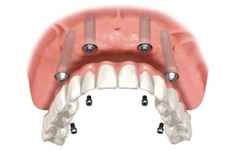 Modern Dentures Calgary Patients Rely On for Stability and Comfort